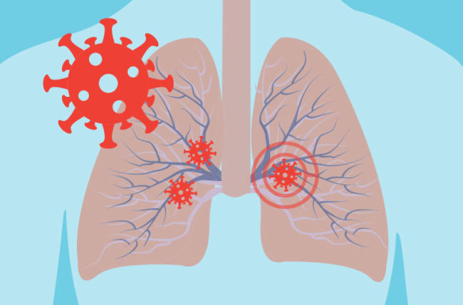 Liponucleotides được phát hiện về khả năng giảm tổn thương giai đoạn muộn của Viêm phổi cấp do virus 5
