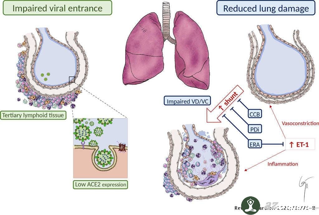 Liponucleotides được phát hiện về khả năng giảm tổn thương giai đoạn muộn của Viêm phổi cấp do virus 9