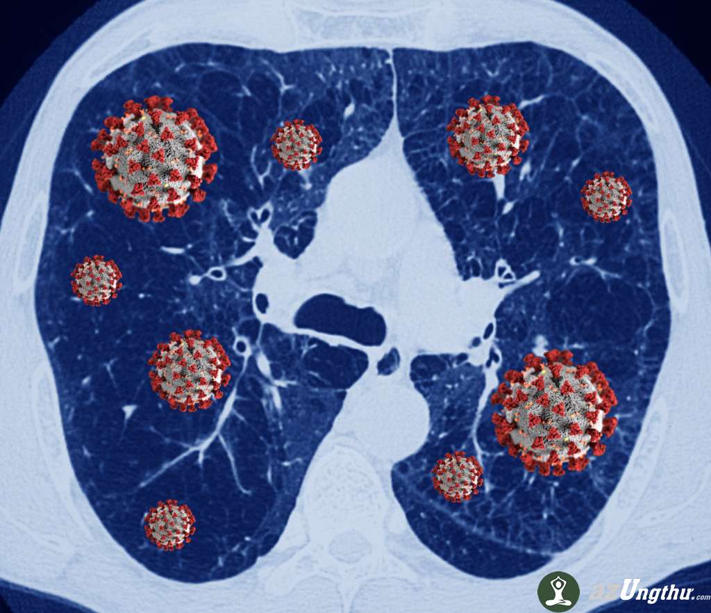 Liponucleotides được phát hiện về khả năng giảm tổn thương giai đoạn muộn của Viêm phổi cấp do virus 6